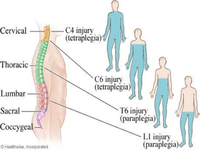 spinal cord injury 22 638 jpg cb 1441824767 severed spinal cord