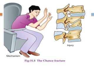Spinal Cord Injury Lecture Presentation for Medical Students.