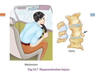 Spinal Cord Injury Lecture Presentation for Medical Students.