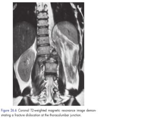 Spinal Cord Injury Lecture Presentation for Medical Students.