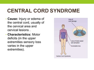 CENTRAL CORD SYNDROME
• Cause: Injury or edema of
the central cord, usually of
the cervical area and
cervical lesions .
• Characteristics: Motor
deficits (in the upper
extremities sensory loss
varies in the upper
extremities).
 