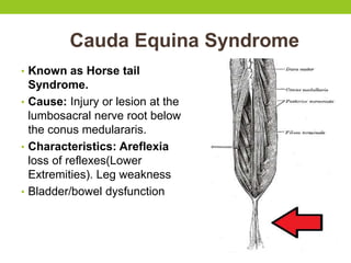 Cauda Equina Syndrome
• Known as Horse tail
Syndrome.
• Cause: Injury or lesion at the
lumbosacral nerve root below
the conus medulararis.
• Characteristics: Areflexia
loss of reflexes(Lower
Extremities). Leg weakness
• Bladder/bowel dysfunction
 