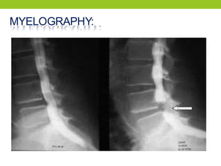 MYELOGRAPHY:
 