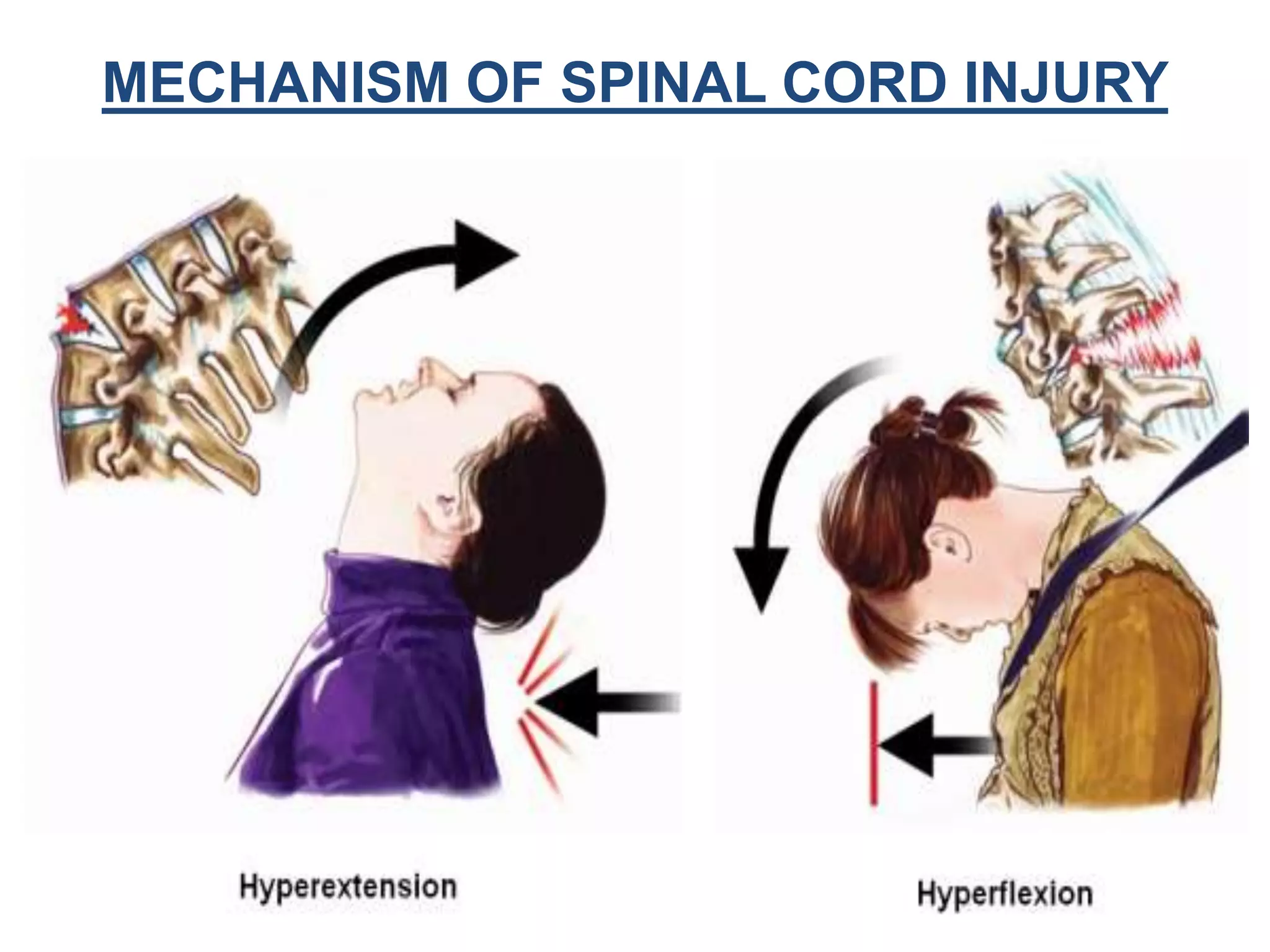 Devil Core Injuries Spinal Cord Injuries | PPTX