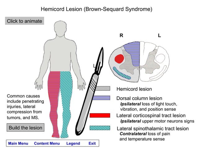 Spinal cord lesions module | PPT
