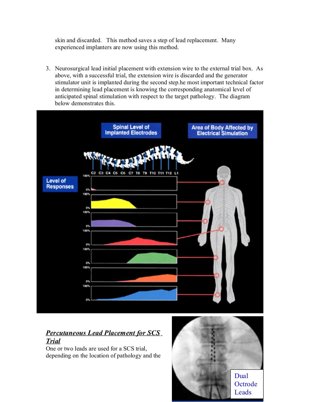 Spinal Cord Stimulation Primer