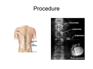 Procedure 