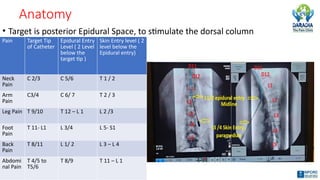 Anatomy
• Target is posterior Epidural Space, to stimulate the dorsal column
Pain Target Tip
of Catheter
Epidural Entry
Level ( 2 Level
below the
target tip )
Skin Entry level ( 2
level below the
Epidural entry)
Neck
Pain
C 2/3 C 5/6 T 1 / 2
Arm
Pain
C3/4 C 6/ 7 T 2 / 3
Leg Pain T 9/10 T 12 – L 1 L 2 /3
Foot
Pain
T 11- L1 L 3/4 L 5- S1
Back
Pain
T 8/11 L 1/ 2 L 3 – L 4
Abdomi
nal Pain
T 4/5 to
T5/6
T 8/9 T 11 – L 1
 