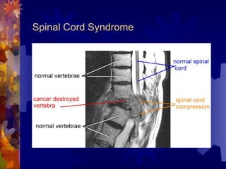 Spinal Cord Syndrome 