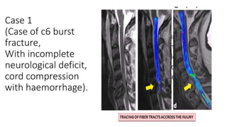 Case 1
(Case of c6 burst
fracture,
With incomplete
neurological deficit,
cord compression
with haemorrhage).
 