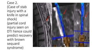 Case 2.
(Case of stab
injury with a
knife in spinal
shock)
(partial cord
injury seen on
DTI hence could
predict recovery
with brown
sequard
syndrome)
 