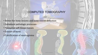 COMPUTED TOMOGRAPHY
• Better for bony lesions and bony extent detection
• Extradural pathologic processes
• Paraspinal soft tissue masses
• Erosion of bone
• Calcification of meningioma
Dodul Mondal
 