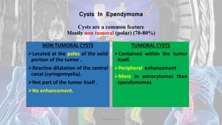 Cysts In Ependymoma
Cysts are a common feature
Mostly non tumoral (polar) (70-80%)
NON TUMORAL CYSTS
Located at the poles of the solid
portion of the tumor .
Reactive dilatation of the central
canal (syringomyelia).
Not part of the tumor itself .
No enhancement.
TUMORAL CYSTS
Contained within the tumor
itself.
Peripheral enhancement
More in astrocytomas than
ependymomas.
Dodul Mondal
 