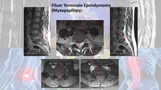 Filum Terminale Ependymoma
(Myxopapillary)
Dodul Mondal
 