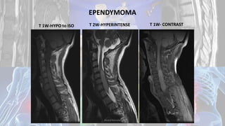EPENDYMOMA
T 1W-HYPO to ISO T 2W-HYPERINTENSE T 1W- CONTRAST
Dodul Mondal
 