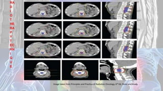 RA
D
I
O
T
HE
RA
P
Y
T
EC
HN
I
Q
U
E
Image taken from Principles and Practice of Radiation Oncology, 6th Ed, Perez and Brady
Dodul Mondal
 