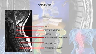 ANATOMY
CSF
DURA
INTERVERTEBRAL DISC
SPINAL CORD
VERTEBRAL BODY
EPIDURAL SPACE
Dodul Mondal
 