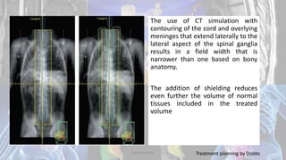 The use of CT simulation with
contouring of the cord and overlying
meninges that extend laterally to the
lateral aspect of the spinal ganglia
results in a field width that is
narrower than one based on bony
anatomy.
The addition of shielding reduces
even further the volume of normal
tissues included in the treated
volume
Treatment planning by DobbsDodul Mondal
 