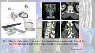Stereotactic radiosurgery for an L1 hemangioblastoma. A single dose of 20
Gy was delivered with CyberKnife using 87 noncoplanar beams
Perez, Sixth Ed
Dodul Mondal
 