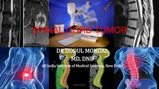 SPINAL CORD TUMOR
DR DODUL MONDAL
MD, DNB
All India Institute of Medical Sciences, New Delhi
Dodul Mondal
 