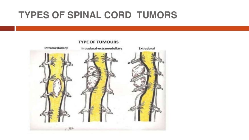 Spinal cord tumors