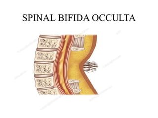 Spinal Defet SPINAL DEFECT of baby when they are born | PPTX