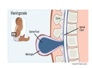 Spinal Defet SPINAL DEFECT of baby when they are born | PPTX