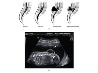 Spinal Defet SPINAL DEFECT of baby when they are born | PPTX
