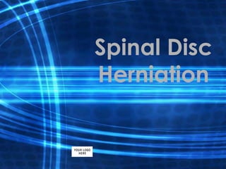 Spinal Disc
Herniation
 