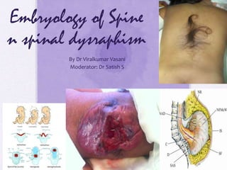 Embryology of Spine
n spinal dysraphism
By Dr Viralkumar Vasani
Moderator: Dr Satish S
 