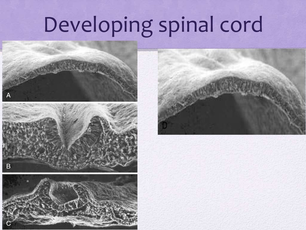 Spinal dysraphism
