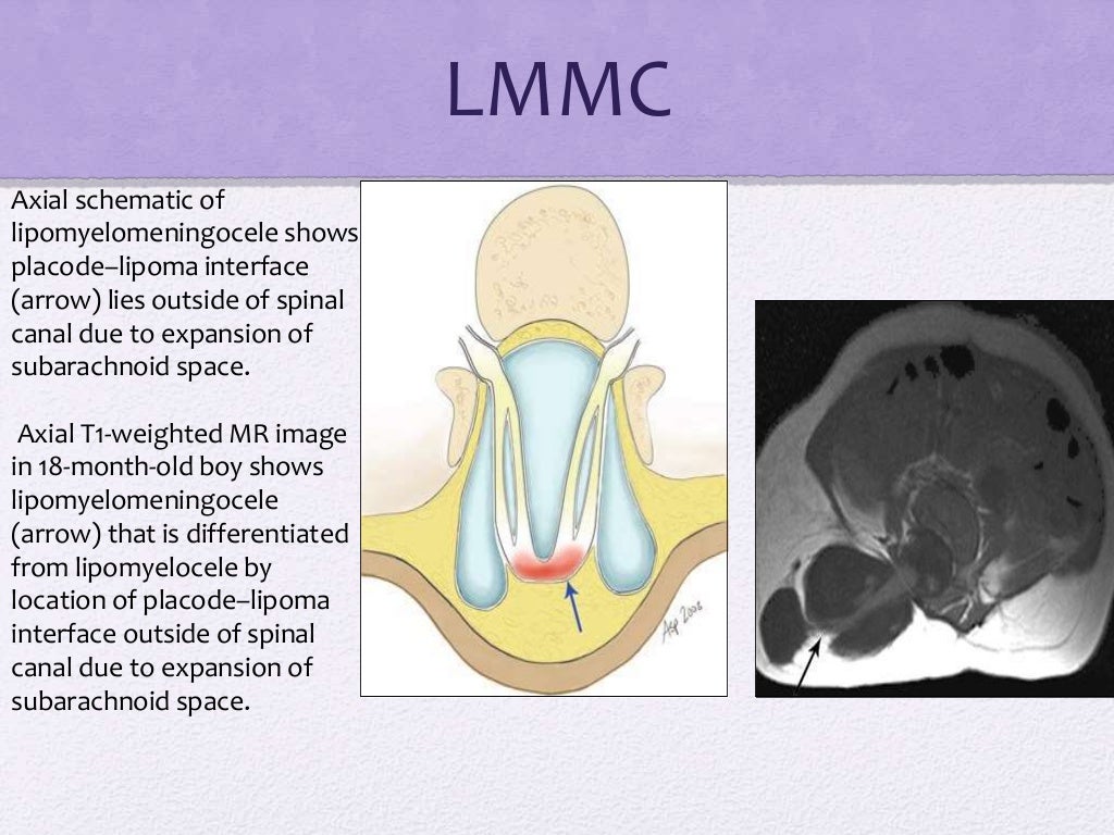 Spinal dysraphism
