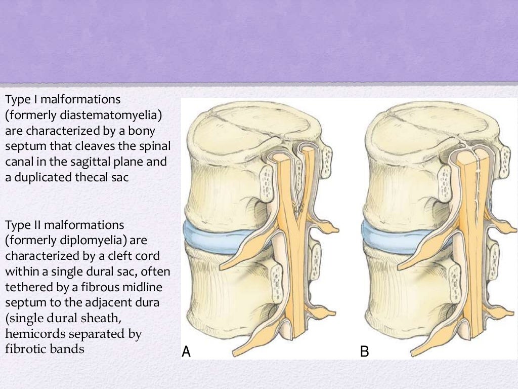 Spinal dysraphism