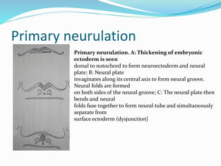 Primary neurulation
Primary neurulation. A: Thickening of embryonic
ectoderm is seen
dorsal to notochord to form neuroectoderm and neural
plate; B: Neural plate
invaginates along its central axis to form neural groove.
Neural folds are formed
on both sides of the neural groove; C: The neural plate then
bends and neural
folds fuse together to form neural tube and simultaneously
separate from
surface ectoderm (dysjunction]
 