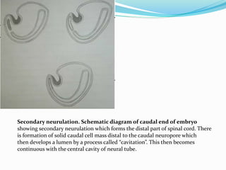 Secondary neurulation. Schematic diagram of caudal end of embryo
showing secondary neurulation which forms the distal part of spinal cord. There
is formation of solid caudal cell mass distal to the caudal neuropore which
then develops a lumen by a process called “cavitation”. This then becomes
continuous with the central cavity of neural tube.
 