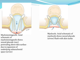 Myelomeningocele. Axial
schematic of
myelomeningocele shows
neural placode (star)
protruding above skin surface
due to expansion of
underlying subarachnoid
space (arrow)
Myelocele. Axial schematic of
myelocele shows neural placode
(arrow) flush with skin surfac
 