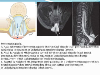 Myelomeningocele.
A, Axial schematic of myelomeningocele shows neural placode (star) protruding above skin
surface due to expansion of underlying subarachnoid space (arrow).
B, Axial T2-weighted MR image in 1-day-old boy shows neural placode (black arrow)
extending above skin surface due to expansion of underlying subarachnoid space
(white arrow), which is characteristic of myelomeningocele.
C, Sagittal T2-weighted MR image from same patient as in B with myelomeningocele shows
neural placode (white arrow) protruding above skin surface due to expansion
of underlying subarachnoid space (black arrow).
 