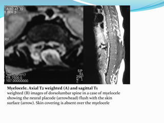Myelocele. Axial T2 weighted (A) and sagittal T1
weighted (B) images of dorsolumbar spine in a case of myelocele
showing the neural placode (arrowhead) flush with the skin
surface (arrow). Skin covering is absent over the myelocele
 