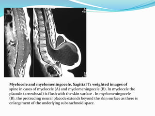 Myelocele and myelomeningocele. Sagittal T1 weighted images of
spine in cases of myelocele (A) and myelomeningocele (B). In myelocele the
placode (arrowhead) is flush with the skin surface . In myelomeningocele
(B), the protruding neural placode extends beyond the skin surface as there is
enlargement of the underlying subarachnoid space.
 