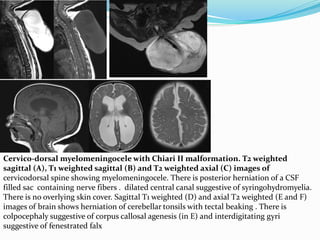 Cervico-dorsal myelomeningocele with Chiari II malformation. T2 weighted
sagittal (A), T1 weighted sagittal (B) and T2 weighted axial (C) images of
cervicodorsal spine showing myelomeningocele. There is posterior herniation of a CSF
filled sac containing nerve fibers . dilated central canal suggestive of syringohydromyelia.
There is no overlying skin cover. Sagittal T1 weighted (D) and axial T2 weighted (E and F)
images of brain shows herniation of cerebellar tonsils with tectal beaking . There is
colpocephaly suggestive of corpus callosal agenesis (in E) and interdigitating gyri
suggestive of fenestrated falx
 