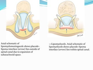 Axial schematic of
lipomyelomeningocele shows placode–
lipoma interface (arrow) lies outside of
spinal canal due to expansion of
subarachnoid space.
—Lipomyelocele. Axial schematic of
lipomyelocele shows placode–lipoma
interface (arrow) lies within spinal canal.
 