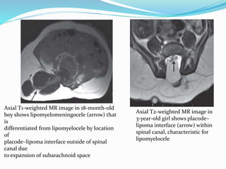 Axial T1-weighted MR image in 18-month-old
boy shows lipomyelomeningocele (arrow) that
is
differentiated from lipomyelocele by location
of
placode–lipoma interface outside of spinal
canal due
to expansion of subarachnoid space
Axial T2-weighted MR image in
3-year-old girl shows placode–
lipoma interface (arrow) within
spinal canal, characteristic for
lipomyelocele
 