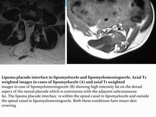 Lipoma placode interface in lipomyelocele and lipomyelomeningocele. Axial T2
weighted images in cases of lipomyelocele (A) and axial T1 weighted
images in case of lipomyelomeningocele (B) showing high intensity fat on the dorsal
aspect of the neural placode which is continuous with the adjacent subcutaneous
fat. The lipoma placode interface is within the spinal canal in lipomyelocele and outside
the spinal canal in lipomyelomeningocele. Both these conditions have intact skin
covering.
 