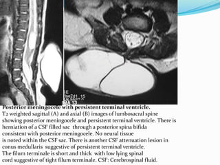 Posterior meningocele with persistent terminal ventricle.
T2 weighted sagittal (A) and axial (B) images of lumbosacral spine
showing posterior meningocele and persistent terminal ventricle. There is
herniation of a CSF filled sac through a posterior spina bifida
consistent with posterior meningocele. No neural tissue
is noted within the CSF sac. There is another CSF attenuation lesion in
conus medullaris suggestive of persistent terminal ventricle.
The filum terminale is short and thick with low lying spinal
cord suggestive of tight filum terminale. CSF: Cerebrospinal fluid.
 