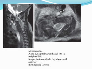 Meningocele.
A and B, Sagittal (A) and axial (B) T2-
weighted MR
images in 6-month-old boy show small
anterior
meningocele (arrows
 