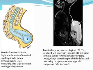 Terminal myelocystocele.
Sagittal schematic of terminal
myelocystocele shows
terminal syrinx (star)
herniating into large posterior
meningocele (arrows)
Terminal myelocystocele. Sagittal (B) T2-
weighted MR images in 1-month-old girl show
terminal syrinx (white arrows) protruding
through large posterior spina bifida defect and
herniating into posterior meningocele
component (black arrows).
 
