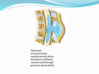 Schematic
of nonterminal
myelocystocele shows
herniation of dilated
central canal through
posterior spinal defect
 