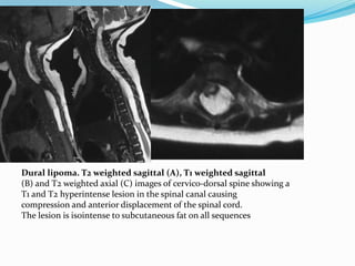 Dural lipoma. T2 weighted sagittal (A), T1 weighted sagittal
(B) and T2 weighted axial (C) images of cervico-dorsal spine showing a
T1 and T2 hyperintense lesion in the spinal canal causing
compression and anterior displacement of the spinal cord.
The lesion is isointense to subcutaneous fat on all sequences
 