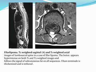 Filarlipoma. T2 weighted sagittal (A) and T1 weighted axial
images of lumbosacral spine in a case of filar lipoma. The lesion appears
hyperintense on both T1 and T2 weighted images and
follows the signal of subcutaneous fat on all sequences. Filum terminale is
thickenined and is tethered .
 