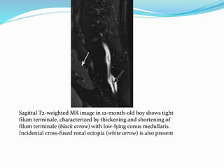Sagittal T2-weighted MR image in 12-month-old boy shows tight
filum terminale, characterized by thickening and shortening of
filum terminale (black arrow) with low-lying conus medullaris.
Incidental cross-fused renal ectopia (white arrow) is also present
 